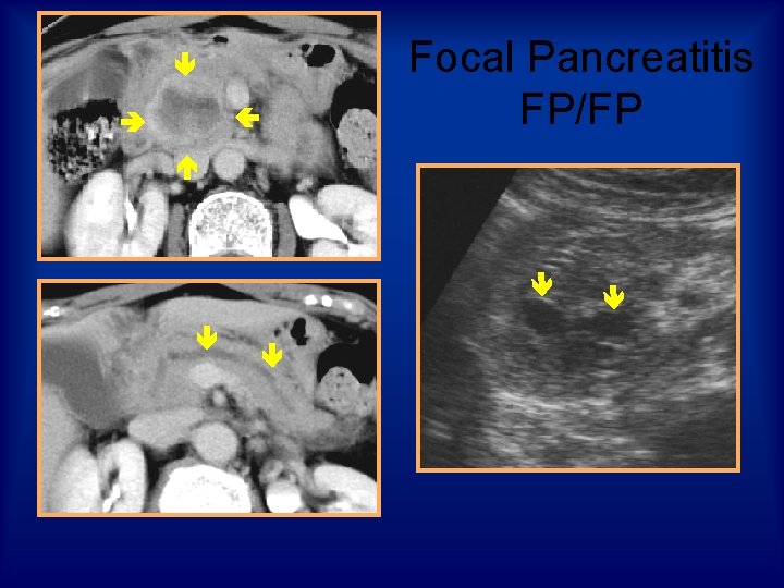 Focal Pancreatitis FP/FP 