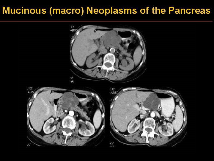 Mucinous (macro) Neoplasms of the Pancreas 