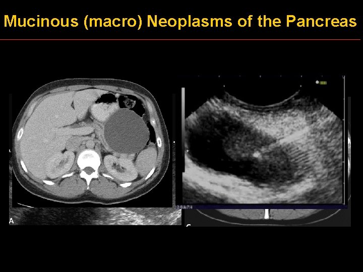 Mucinous (macro) Neoplasms of the Pancreas 