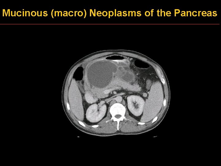 Mucinous (macro) Neoplasms of the Pancreas 