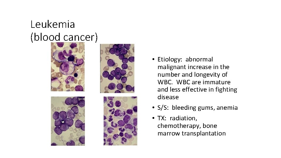 Leukemia (blood cancer) • Etiology: abnormal malignant increase in the number and longevity of