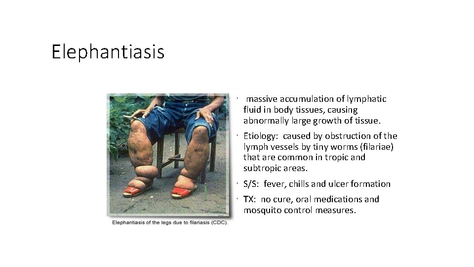 Elephantiasis • massive accumulation of lymphatic fluid in body tissues, causing abnormally large growth