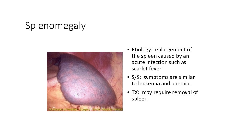 Splenomegaly • Etiology: enlargement of the spleen caused by an acute infection such as
