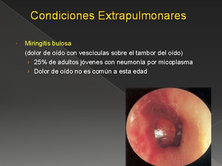 Condiciones Extrapulmonares Miringitis bulosa (dolor de oído con vescículas sobre el tambor del oído)