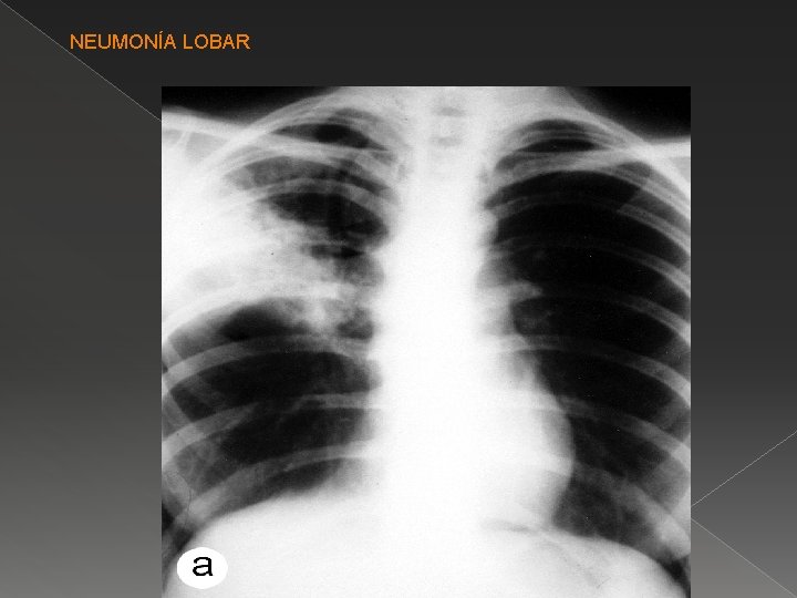 NEUMONÍA LOBAR 