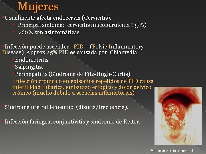 Mujeres • Usualmente afecta endocervix (Cervicitis). • Principal síntoma: cervicitis mucopurulenta (37%) • >60%