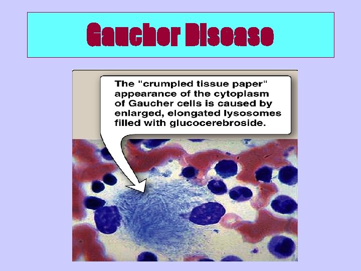 Gaucher Disease 