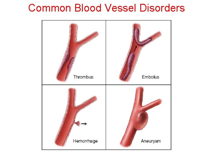 Common Blood Vessel Disorders Common Blood Vessel Disorders