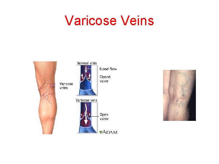 Varicose Veins 