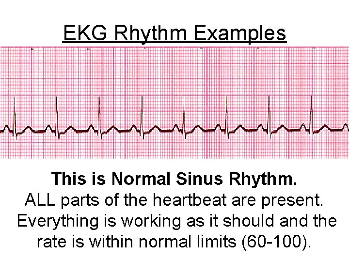 EKG Rhythm Examples This is Normal Sinus Rhythm. ALL parts of the heartbeat are