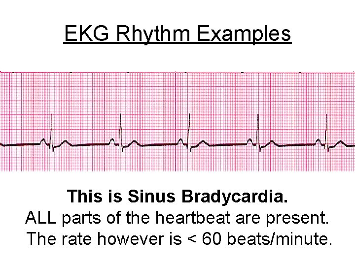 EKG Rhythm Examples This is Sinus Bradycardia. ALL parts of the heartbeat are present.