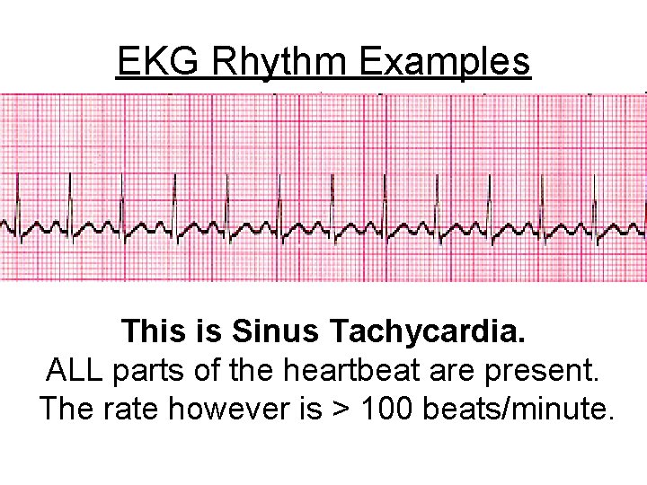 EKG Rhythm Examples This is Sinus Tachycardia. ALL parts of the heartbeat are present.