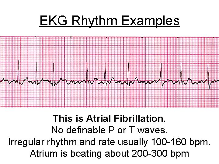 EKG Rhythm Examples This is Atrial Fibrillation. No definable P or T waves. Irregular