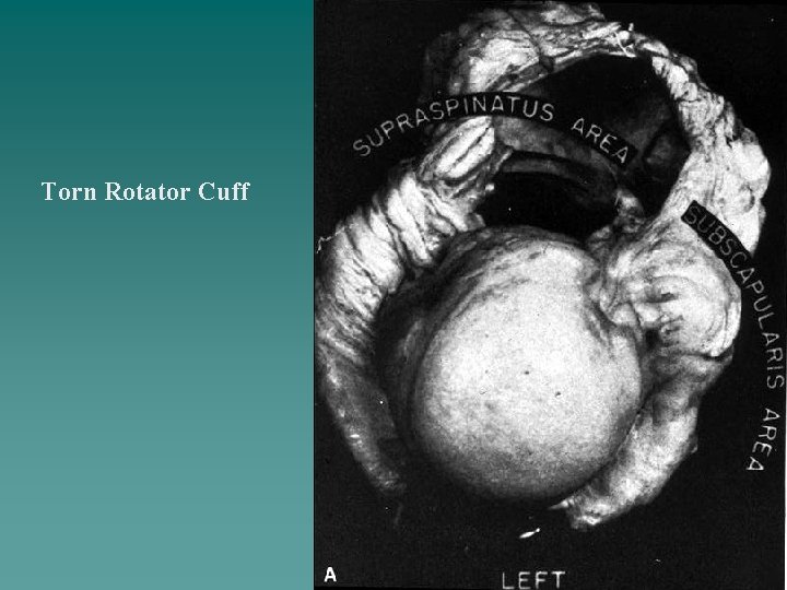Torn Rotator Cuff 