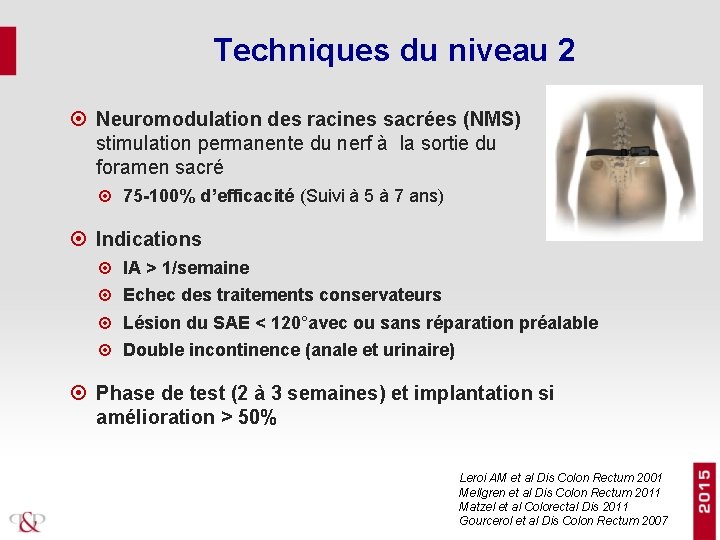 Techniques du niveau 2 Neuromodulation des racines sacrées (NMS) stimulation permanente du nerf à