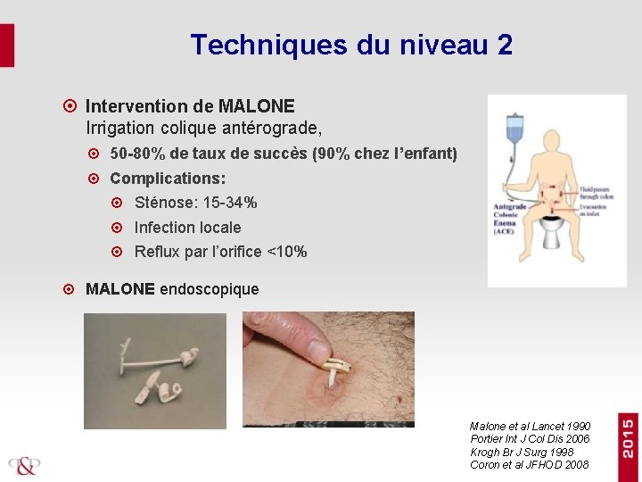 Techniques du niveau 2 Intervention de MALONE Irrigation colique antérograde, 50 -80% de taux