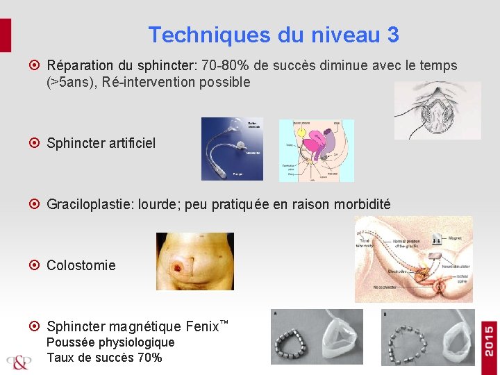 Techniques du niveau 3 Réparation du sphincter: 70 -80% de succès diminue avec le