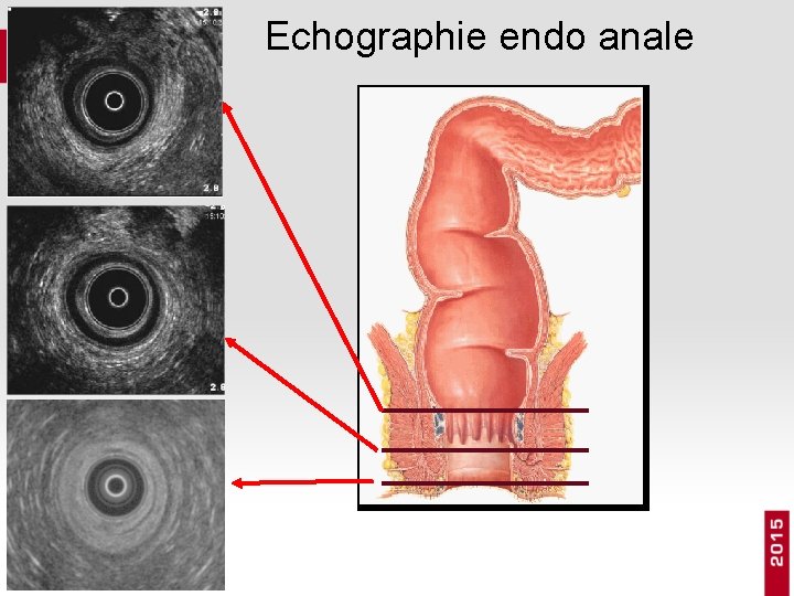 Echographie endo anale 