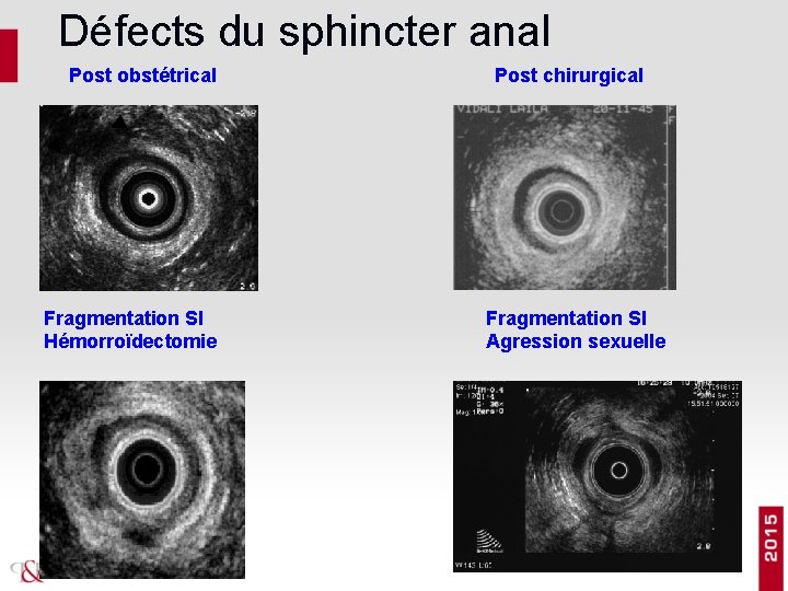 Défects du sphincter anal Post obstétrical Fragmentation SI Hémorroïdectomie Post chirurgical Fragmentation SI Agression