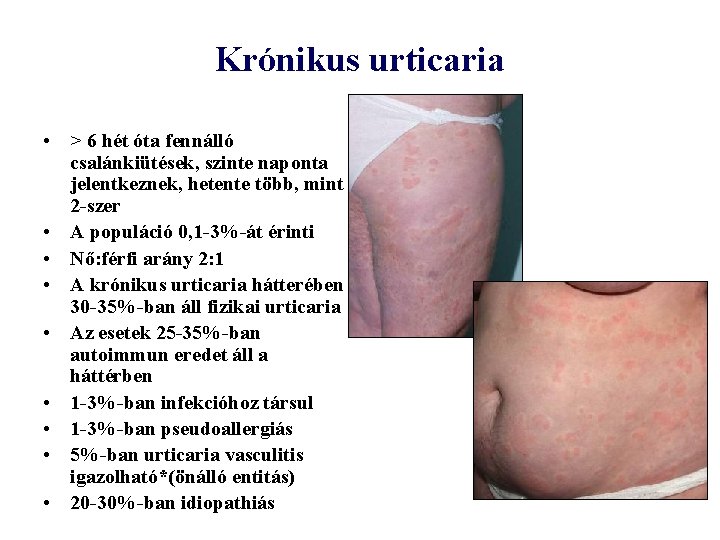 Krónikus urticaria • > 6 hét óta fennálló csalánkiütések, szinte naponta jelentkeznek, hetente több,