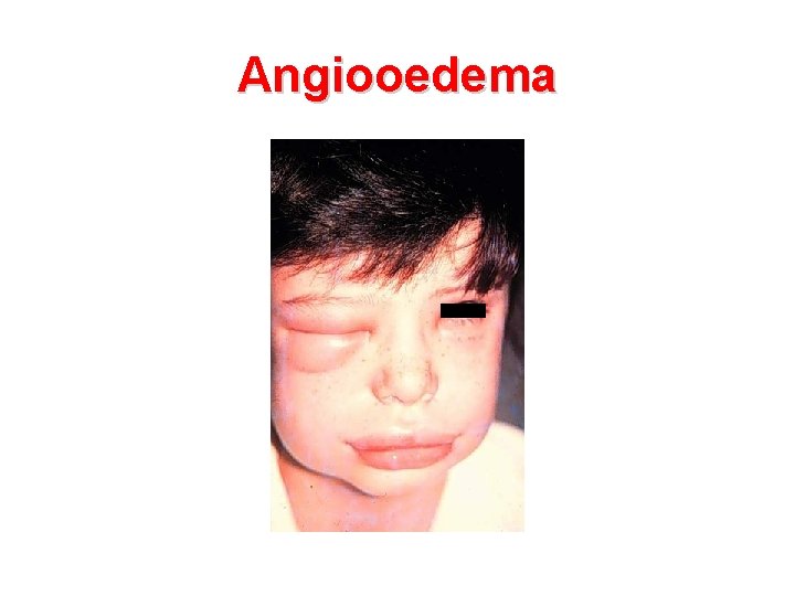Angiooedema 