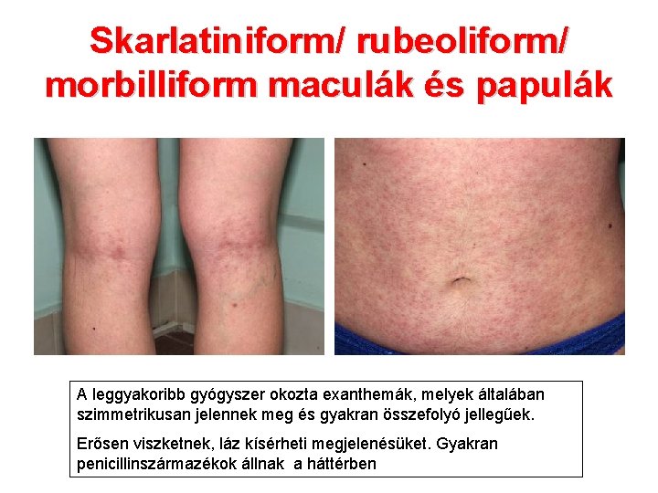Skarlatiniform/ rubeoliform/ morbilliform maculák és papulák A leggyakoribb gyógyszer okozta exanthemák, melyek általában szimmetrikusan