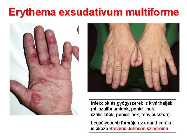 Erythema exsudativum multiforme Infekciók és gyógyszerek is kiválthatják (pl. szulfonamidok, penicillinek, szalicilátok, penicillinek, fenylbutazon).