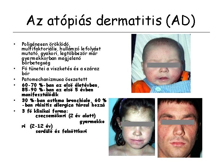 Az atópiás dermatitis (AD) • • • Poligénesen öröklődő, multifaktoriális, hullámzó lefolyást mutató, gyakori,