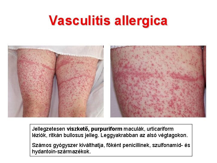 Vasculitis allergica Jellegzetesen viszkető, purpuriform maculák, urticariform léziók, ritkán bullosus jelleg. Leggyakrabban az alsó