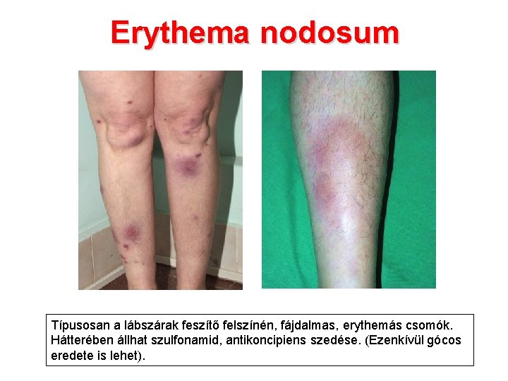 Erythema nodosum Típusosan a lábszárak feszítő felszínén, fájdalmas, erythemás csomók. Hátterében állhat szulfonamid, antikoncipiens