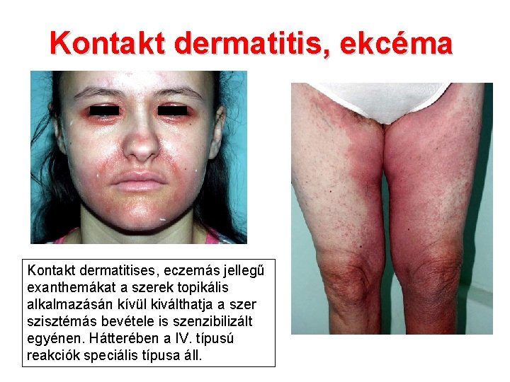Kontakt dermatitis, ekcéma Kontakt dermatitises, eczemás jellegű exanthemákat a szerek topikális alkalmazásán kívül kiválthatja