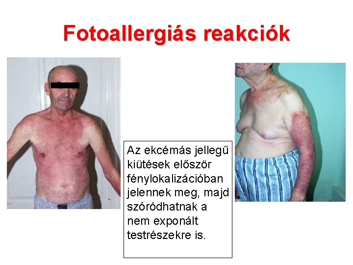 Fotoallergiás reakciók Az ekcémás jellegű kiütések először fénylokalizációban jelennek meg, majd szóródhatnak a nem