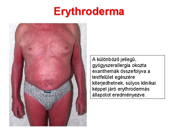 Erythroderma A különböző jellegű, gyógyszerallergia okozta exanthemák összefolyva a testfelület egészére kiterjedhetnek, súlyos klinikai