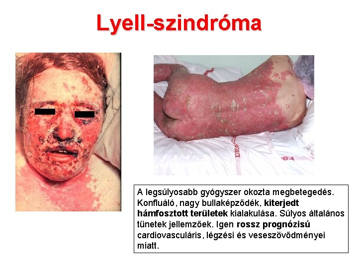 Lyell-szindróma A legsúlyosabb gyógyszer okozta megbetegedés. Konfluáló, nagy bullaképződék, kiterjedt hámfosztott területek kialakulása. Súlyos