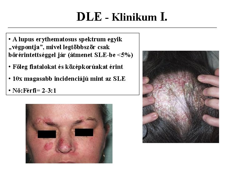 DLE - Klinikum I. • A lupus erythematosus spektrum egyik „végpontja”, mivel legtöbbször csak