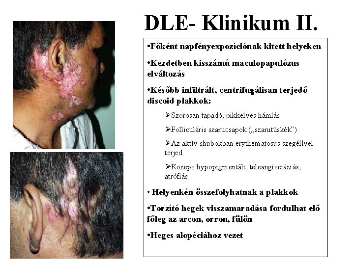 DLE- Klinikum II. • Főként napfényexpozíciónak kitett helyeken • Kezdetben kisszámú maculopapulózus elváltozás •