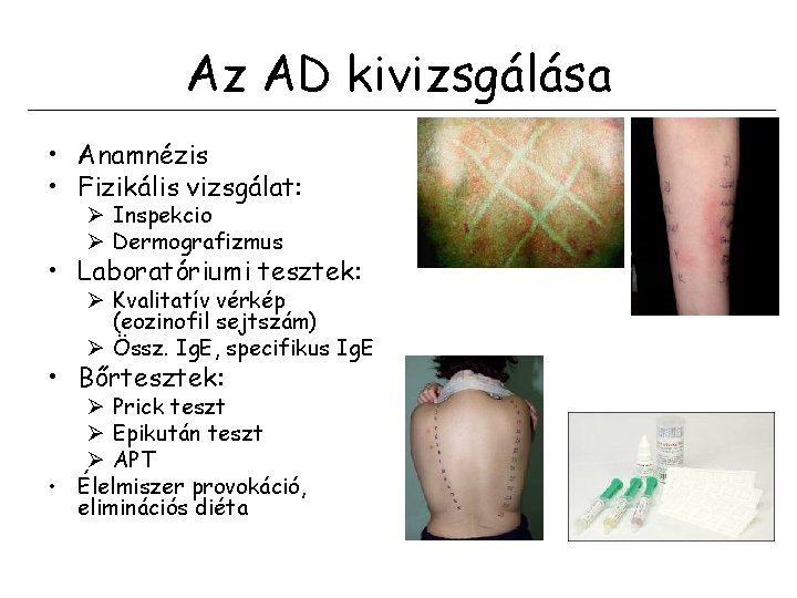 Az AD kivizsgálása • Anamnézis • Fizikális vizsgálat: Ø Inspekcio Ø Dermografizmus • Laboratóriumi