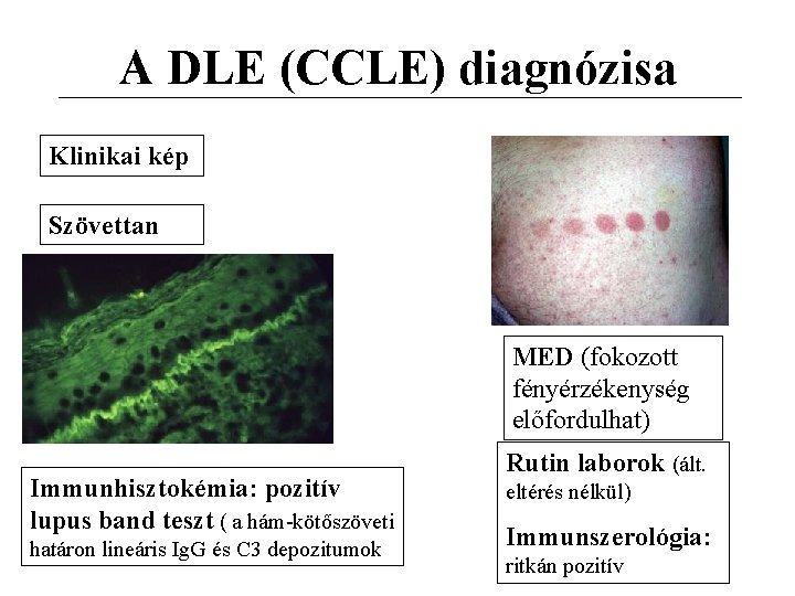A DLE (CCLE) diagnózisa Klinikai kép Szövettan MED (fokozott fényérzékenység előfordulhat) Immunhisztokémia: pozitív lupus