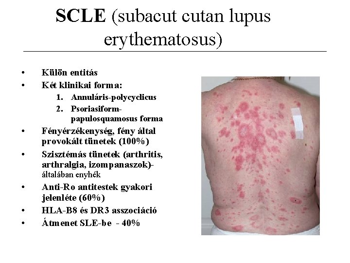 SCLE (subacut cutan lupus erythematosus) • • Külön entitás Két klinikai forma: 1. Annuláris-polycyclicus