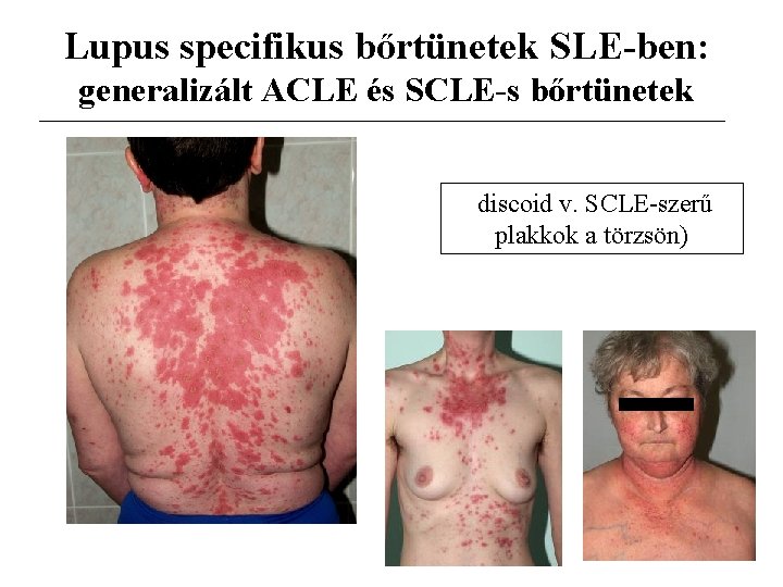 Lupus specifikus bőrtünetek SLE-ben: generalizált ACLE és SCLE-s bőrtünetek discoid v. SCLE-szerű plakkok a