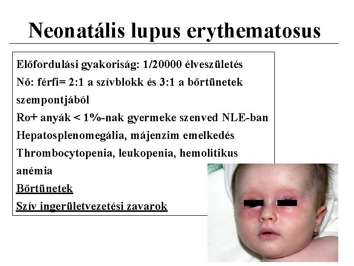 Neonatális lupus erythematosus Előfordulási gyakoriság: 1/20000 élveszületés Nő: férfi= 2: 1 a szívblokk és
