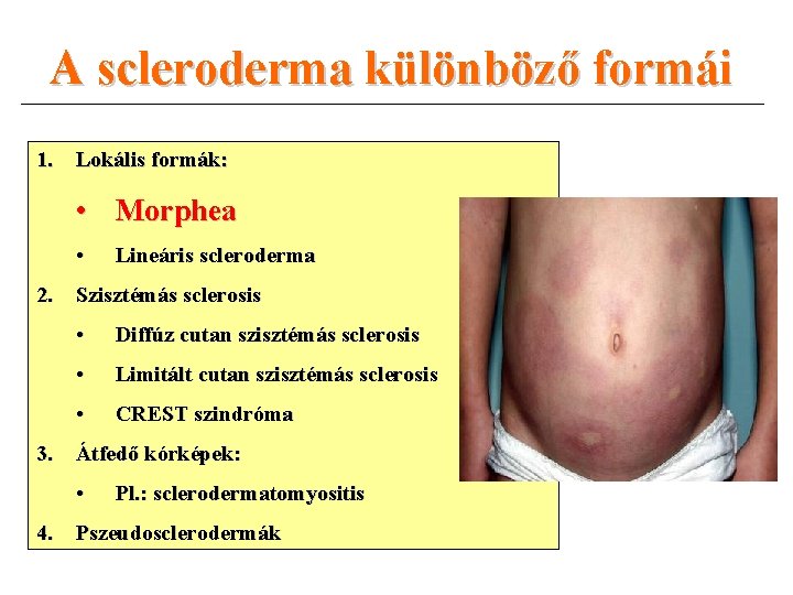 A scleroderma különböző formái 1. Lokális formák: • Morphea • Lineáris scleroderma 2. Szisztémás