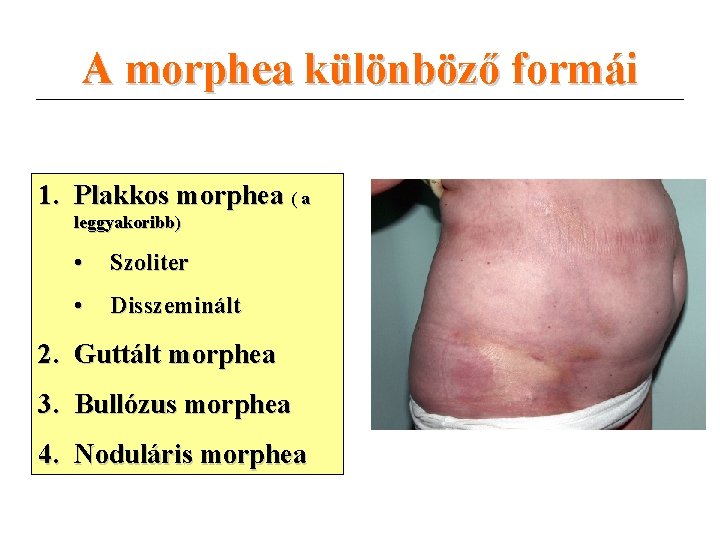 A morphea különböző formái 1. Plakkos morphea ( a leggyakoribb) • Szoliter • Disszeminált