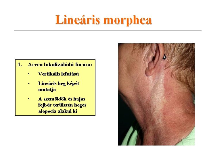 Lineáris morphea 1. Arcra lokalizálódó forma: • Vertikális lefutású • Lineáris heg képét mutatja