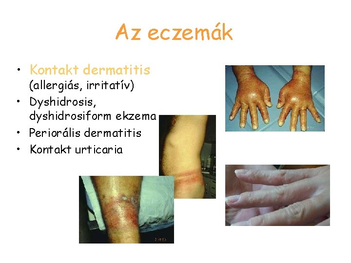 Az eczemák • Kontakt dermatitis (allergiás, irritatív) • Dyshidrosis, dyshidrosiform ekzema • Periorális dermatitis