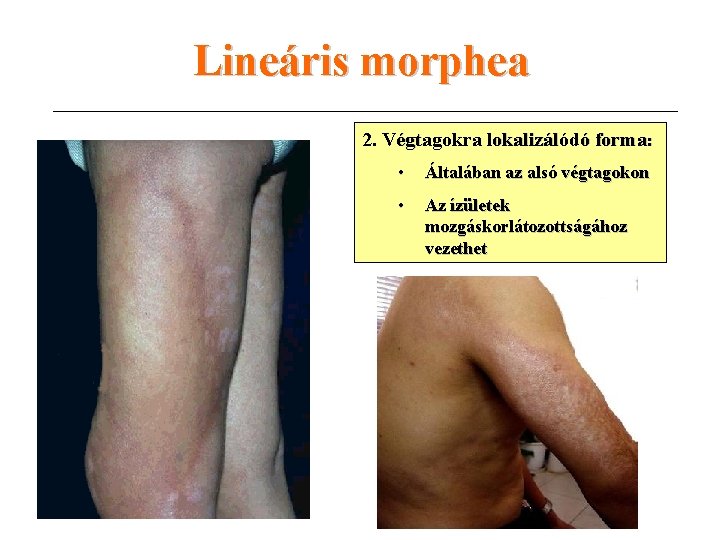 Lineáris morphea 2. Végtagokra lokalizálódó forma: • Általában az alsó végtagokon • Az ízületek