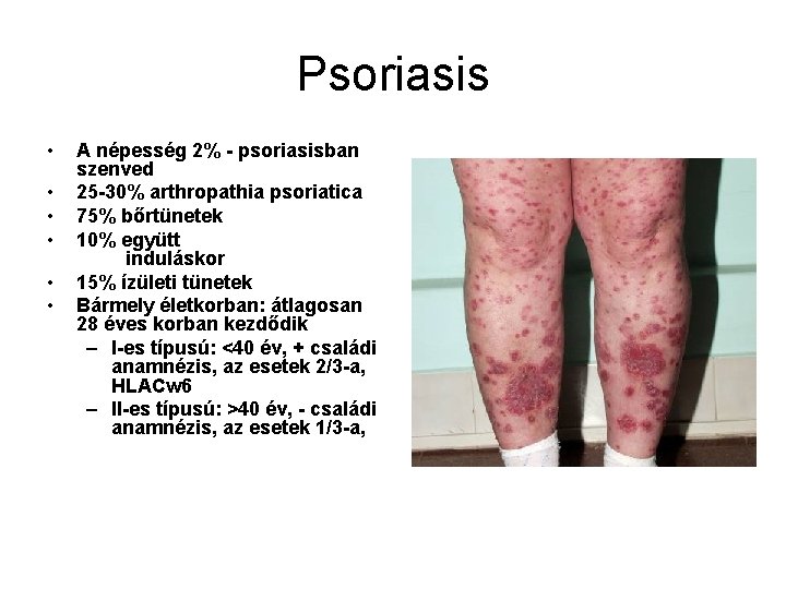 Psoriasis • • • A népesség 2% - psoriasisban szenved 25 -30% arthropathia psoriatica