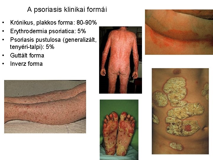 A psoriasis klinikai formái • Krónikus, plakkos forma: 80 -90% • Erythrodermia psoriatica: 5%