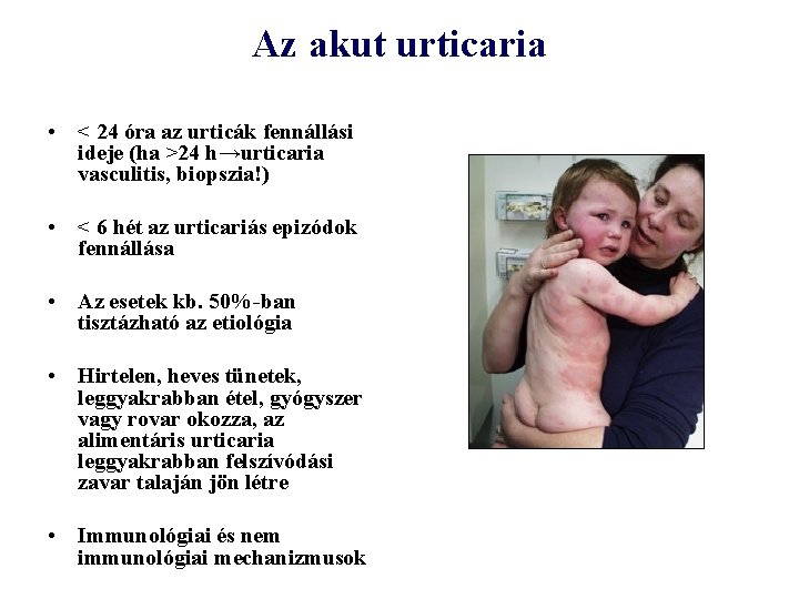 Az akut urticaria • < 24 óra az urticák fennállási ideje (ha >24 h→urticaria