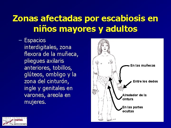 Zonas afectadas por escabiosis en niños mayores y adultos – Espacios interdigitales, zona flexora